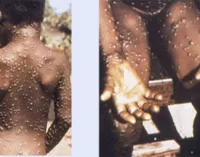 CHILDREN AT RISK OF SEVERE MONKEYPOX CASES, NCDC WARNS