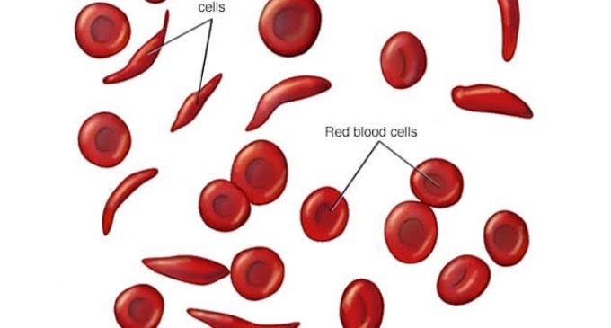 LAGOS GOVERNMENT WARNS RESIDENTS ON SICKLE CELL